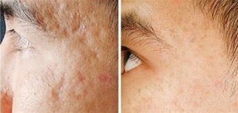 Derma Roller Before & After Pictures|Acne Scars, Stretch marks etc