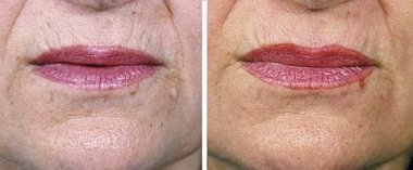 Derma Roller Wrinkles Before and After