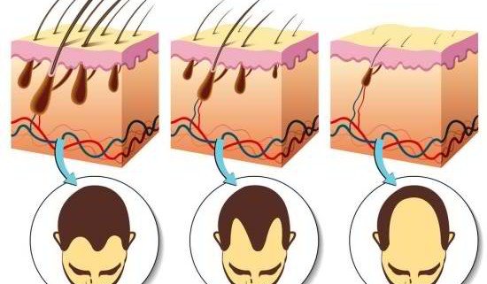 Bald Hair No More: Can Dermarolling Prevent Hair Loss? - Derma Roller Shop