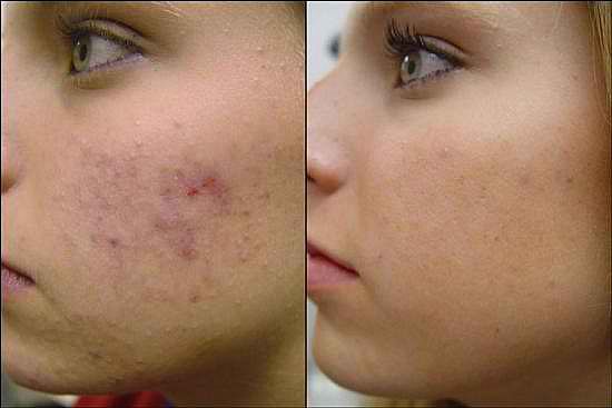 H1 post acne scars