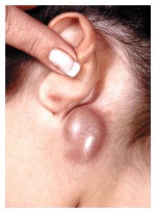 M1 swollen lymph nodes