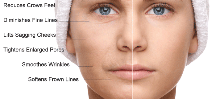 Microneedling before and after