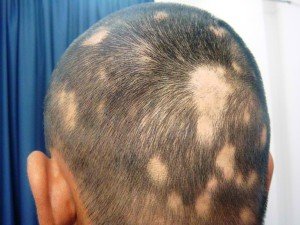 alopecia 1