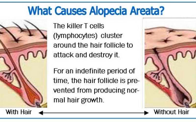 Is Microneedling Effective For Alopecia Or Hair Loss What Are The Updates On Hair Loss Treatment Derma Roller Shop