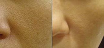 Derma Roller Before And After Picture Whitening