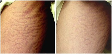 Derma Rollers For Stretch Marks Before And After