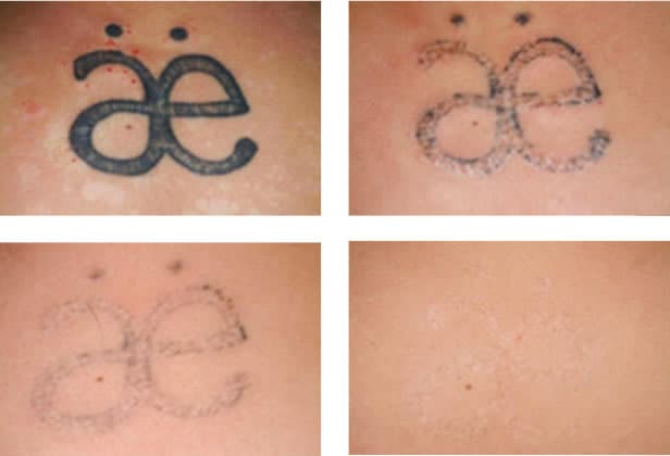 St-Eustache women claim tattoo-removal treatment resulted in 2nd-degree  burns | CTV News